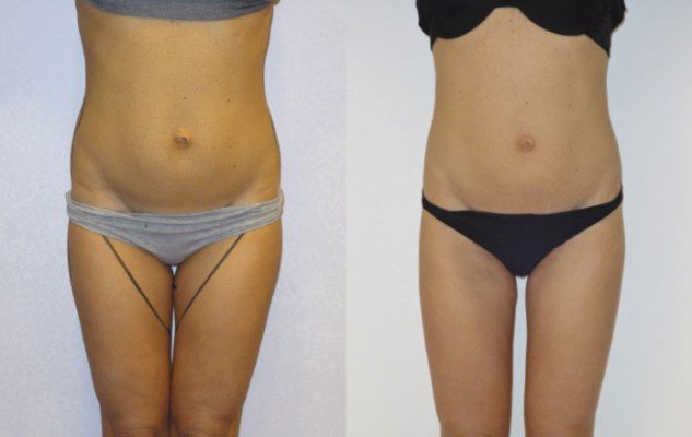 liposuccion laser tunisie